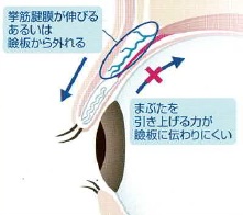 眼瞼下垂の目