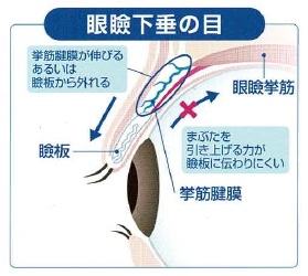 眼瞼下垂の目