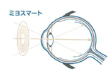 ミヨスマートによる補正
